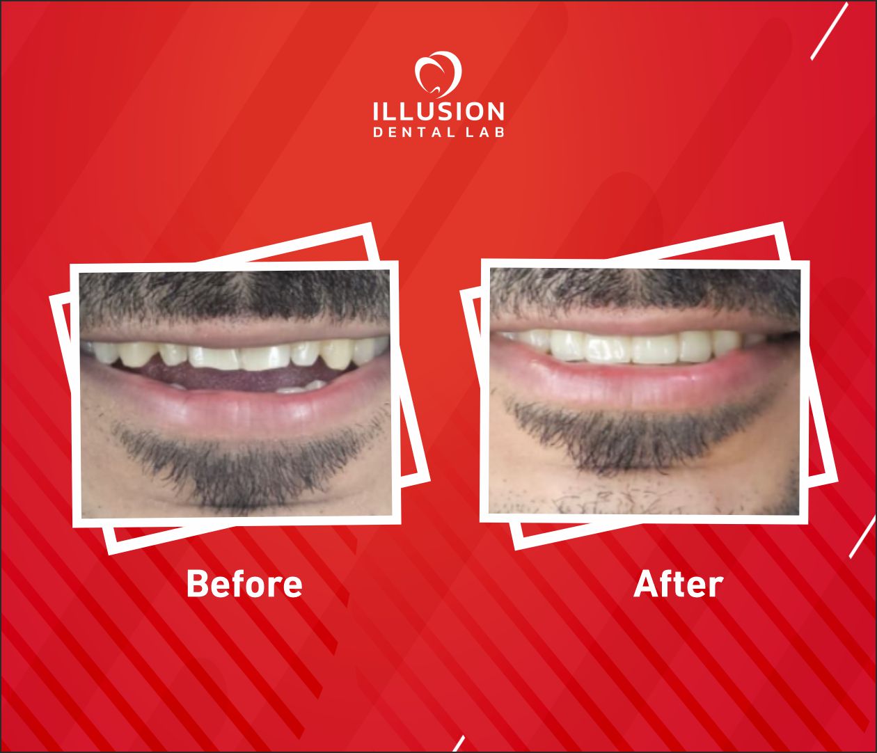 Zirconia crown used for anterior restoration